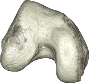 Dysplastic Trochlea